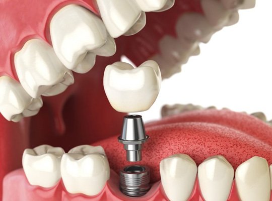  a digital illustration of a dental implant, abutment, and restoration