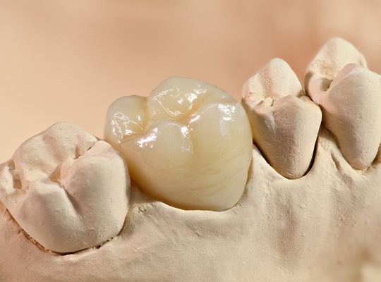 Closeup of smile model with dental crown