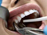 A dentist using forceps to grab a patient’s tooth