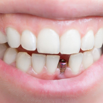 A person with a dental implant
