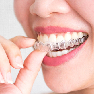 A woman putting on an Invisalign aligner