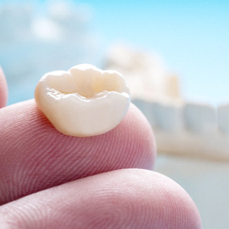 A CEREC Dental Crown