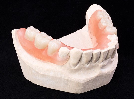 Model smile with partial denture