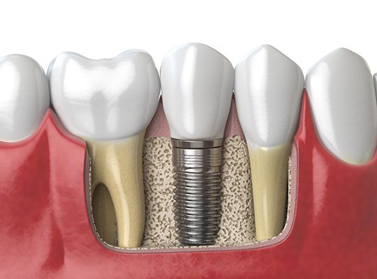 Illustration of a single dental implant in lower arch