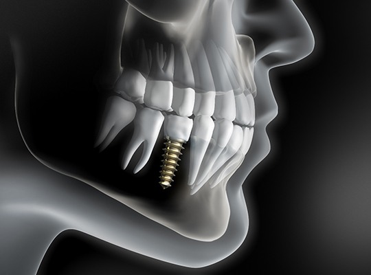 Illustration of X-ray of dental implant and crown