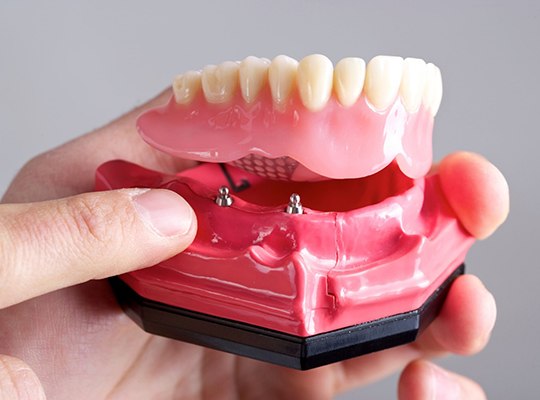 implant dentist in Parma Heights holding a model of an implant denture