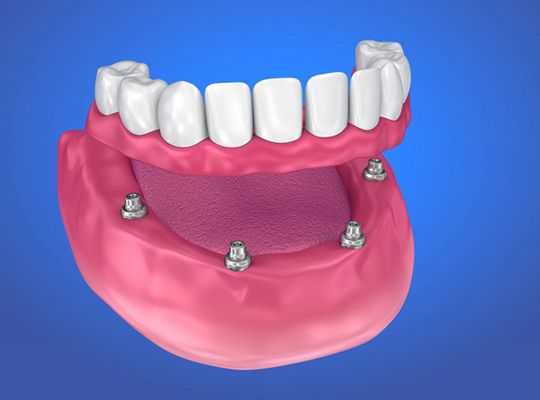 four dental implants in Parma Heights supporting a full denture 