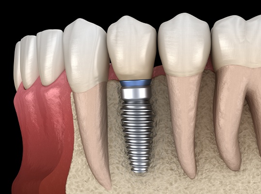 Animation of smile with dental implant
