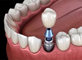 Animation of implant supported dental crown placement