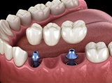 Animation of implant supported fixed bridge placement