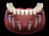 Animation of implant supported denture placement