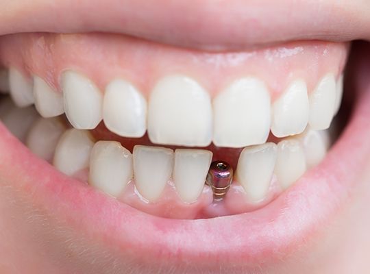Smile with dental implant visible