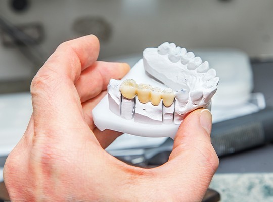 Model smile with fixed brdige restoration