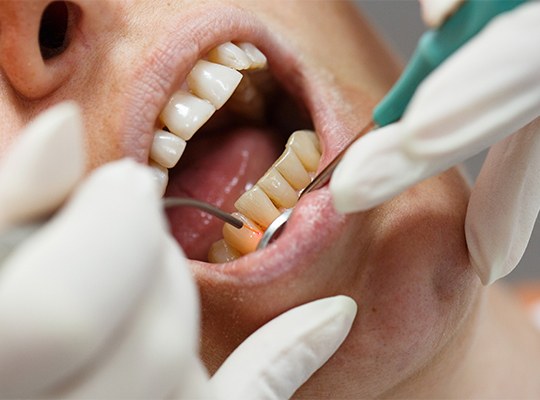 Patient receiving hard tissue laser dentistry treatment