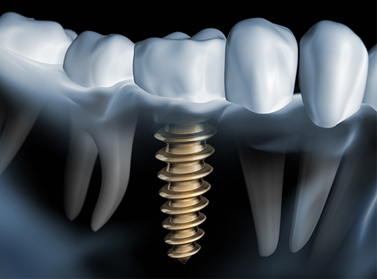 Animation of smile with dental implant