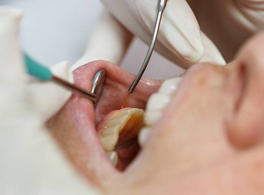 Patient receiving laser gum disease therapy