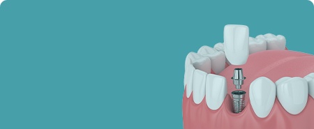 Animated dental implant with crown replacing missing tooth