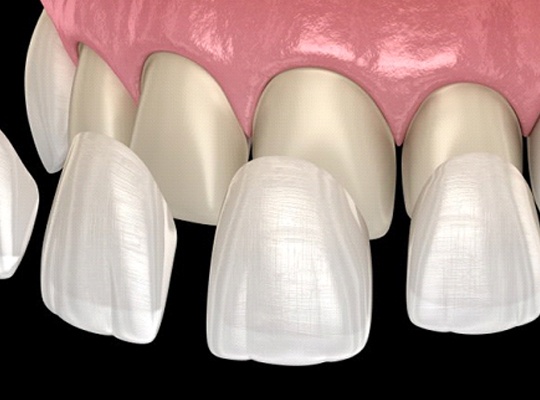 model of veneers being placed on a patient’s teeth