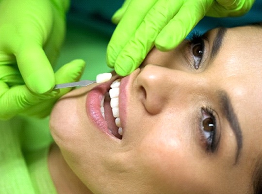 cosmetic dentist in Parma Heights placing a veneer on a patient’s tooth