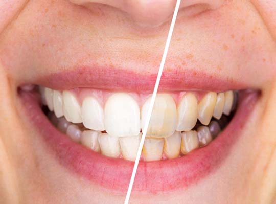 Teeth whitening in Parma Heights before and after
