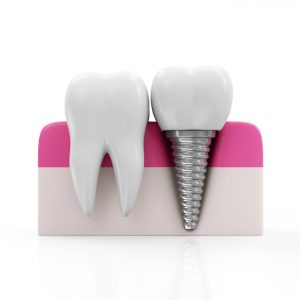 Dental implants can fix missing teeth if you’re a candidate.