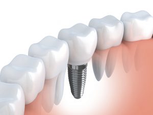 dental implants
