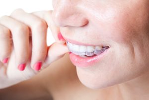 Why should I get Invisalign in Parma Heights?
