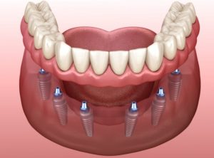 Implant Supported Dentures