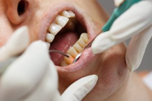 person receiving laser periodontal therapy in Parma Heights
