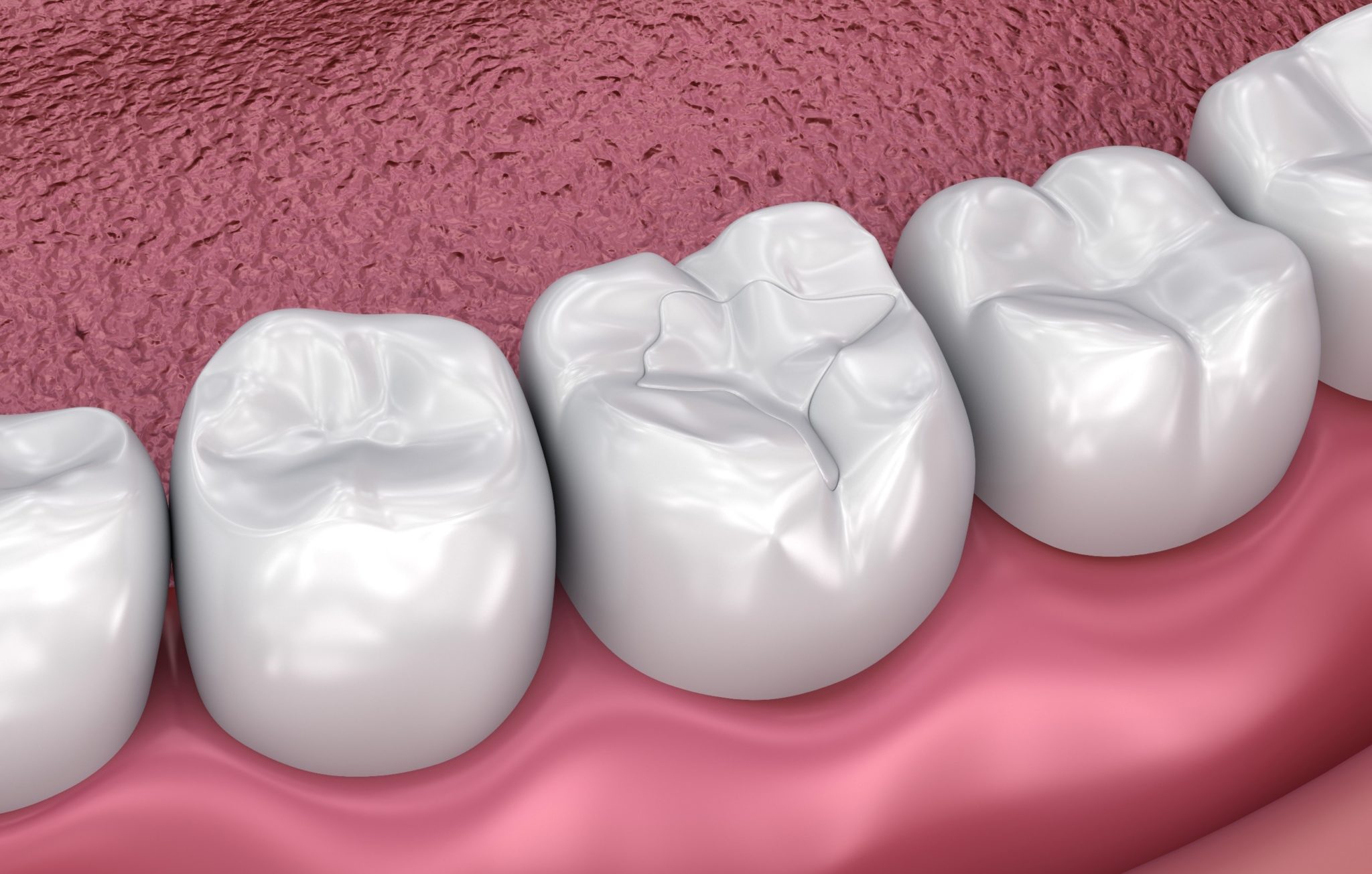 Use Your Dental Insurance For Affordable Fillings