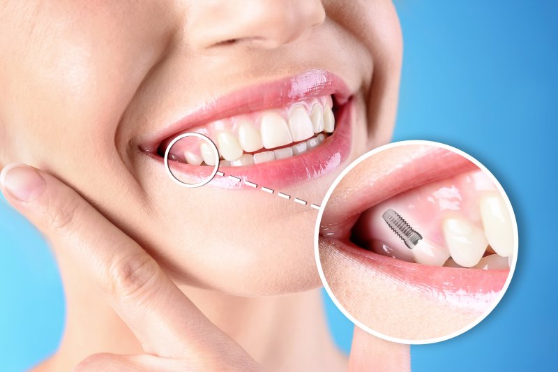 a person with a dental implant in their smile